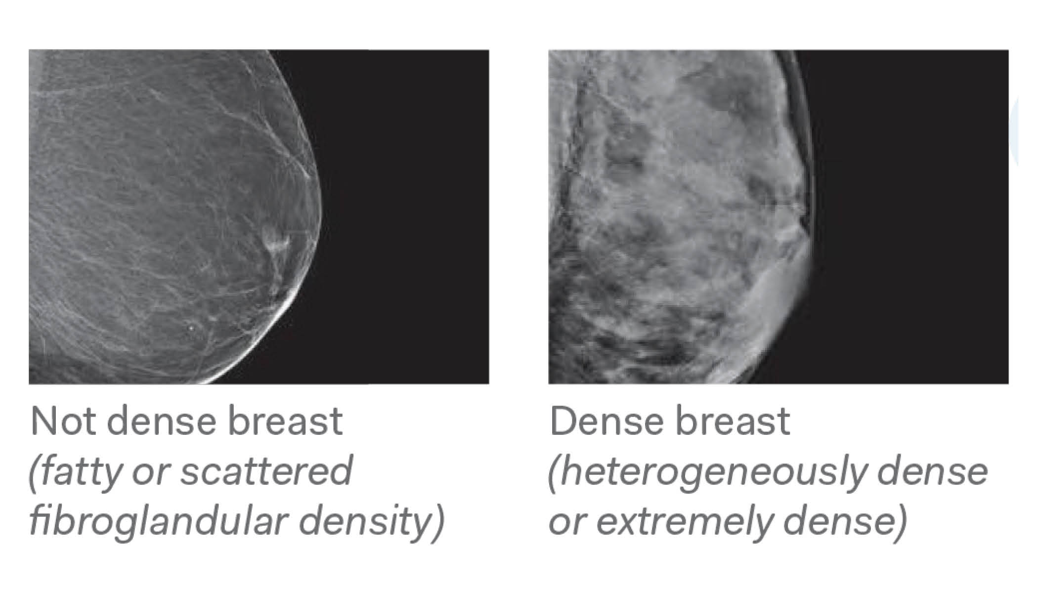 Breast Density 1 Diagnostic Imaging Nw