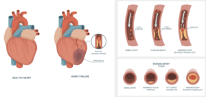 Coronary Heart Disease